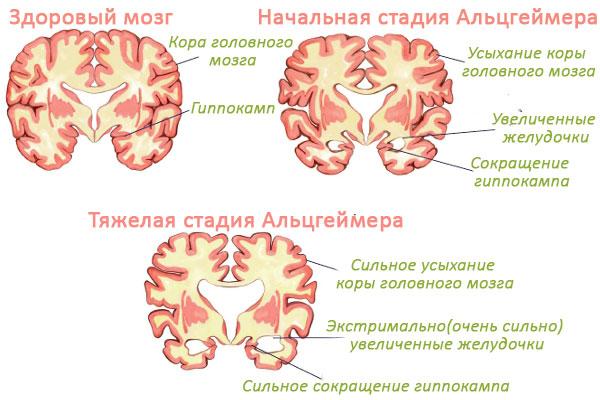 Стадии болезни Альцгеймера