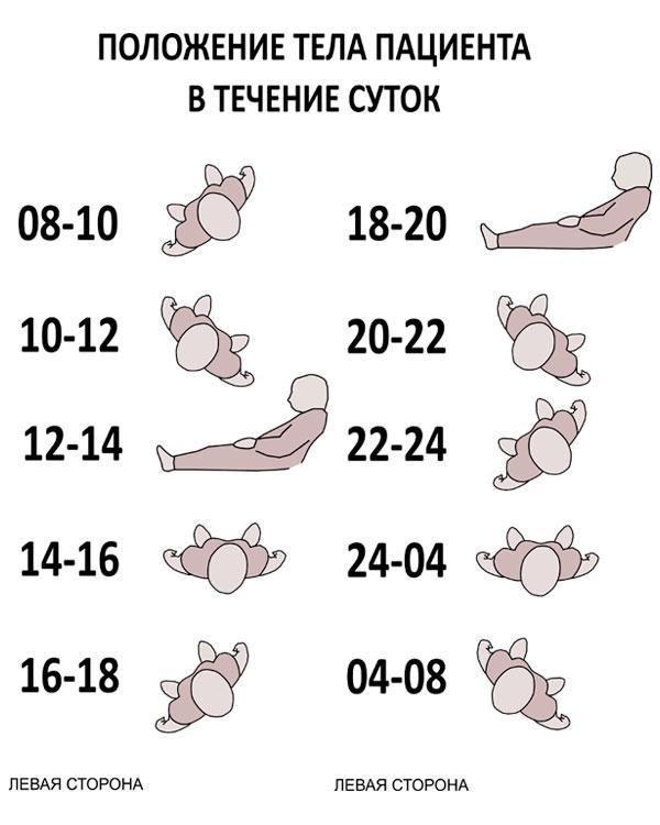 профилактика пролежней