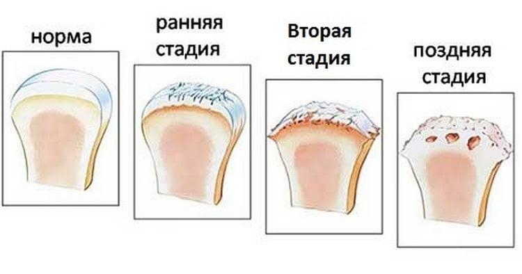 стадии артроза