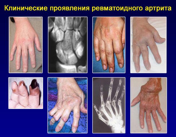 проявление артрита