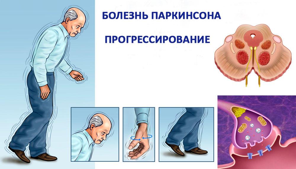прогрессирование болезни паркинсона