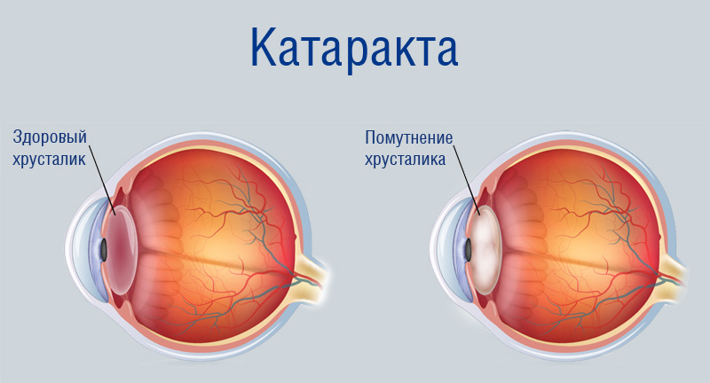 болезнь катаракта