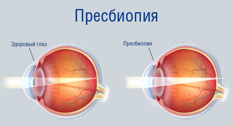 болезнь пресбиопия