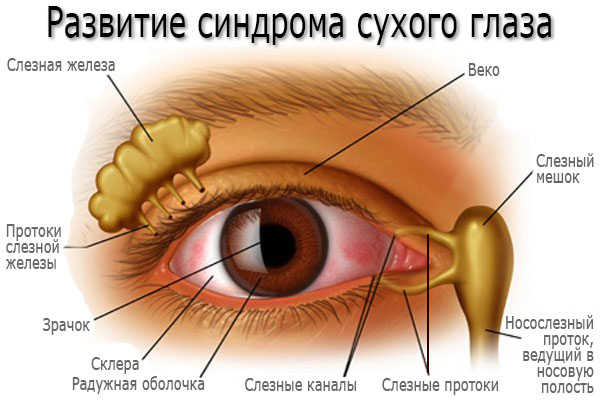 синдром сухого глаза